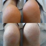 Voor en na resultaat van een droge hiel tijdens de Masterclass Footlogix Cosmetische Pedicure
