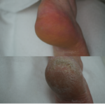 Voor en na resultaat van een droge hiel tijdens de Masterclass Footlogix Cosmetische Pedicure
